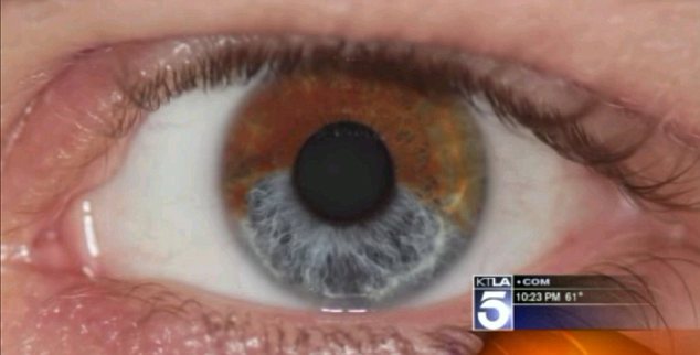 Un Doctor Din California Poate Schimba Culoarea Ochilor Din Caprui